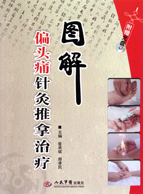 图解偏头痛针灸推拿治