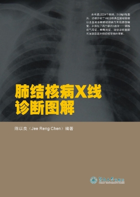 肺结核病X线诊断图解