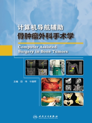 计算机导航辅助骨肿瘤
