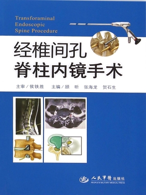 经椎间孔脊柱内镜手术