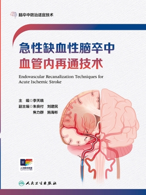 急性缺血性脑卒中血管