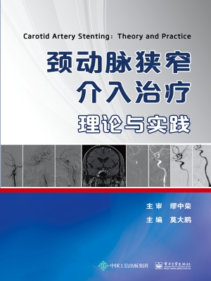 颈动脉狭窄介入治疗—