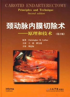 颈动脉内膜切除术——