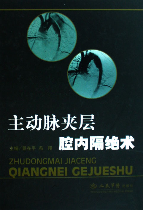 主动脉夹层腔内隔绝术