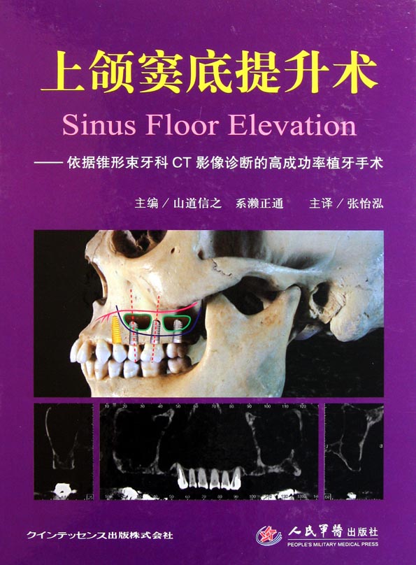 上颌窦底提升术——依