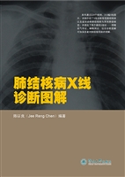 肺结核病X线诊断图解