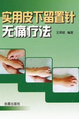 实用皮下留置针无痛疗