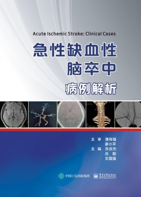 急性缺血性脑卒中病例